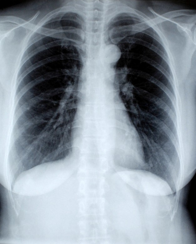Tüdőszűrő vizsgálat Litéren | Litér